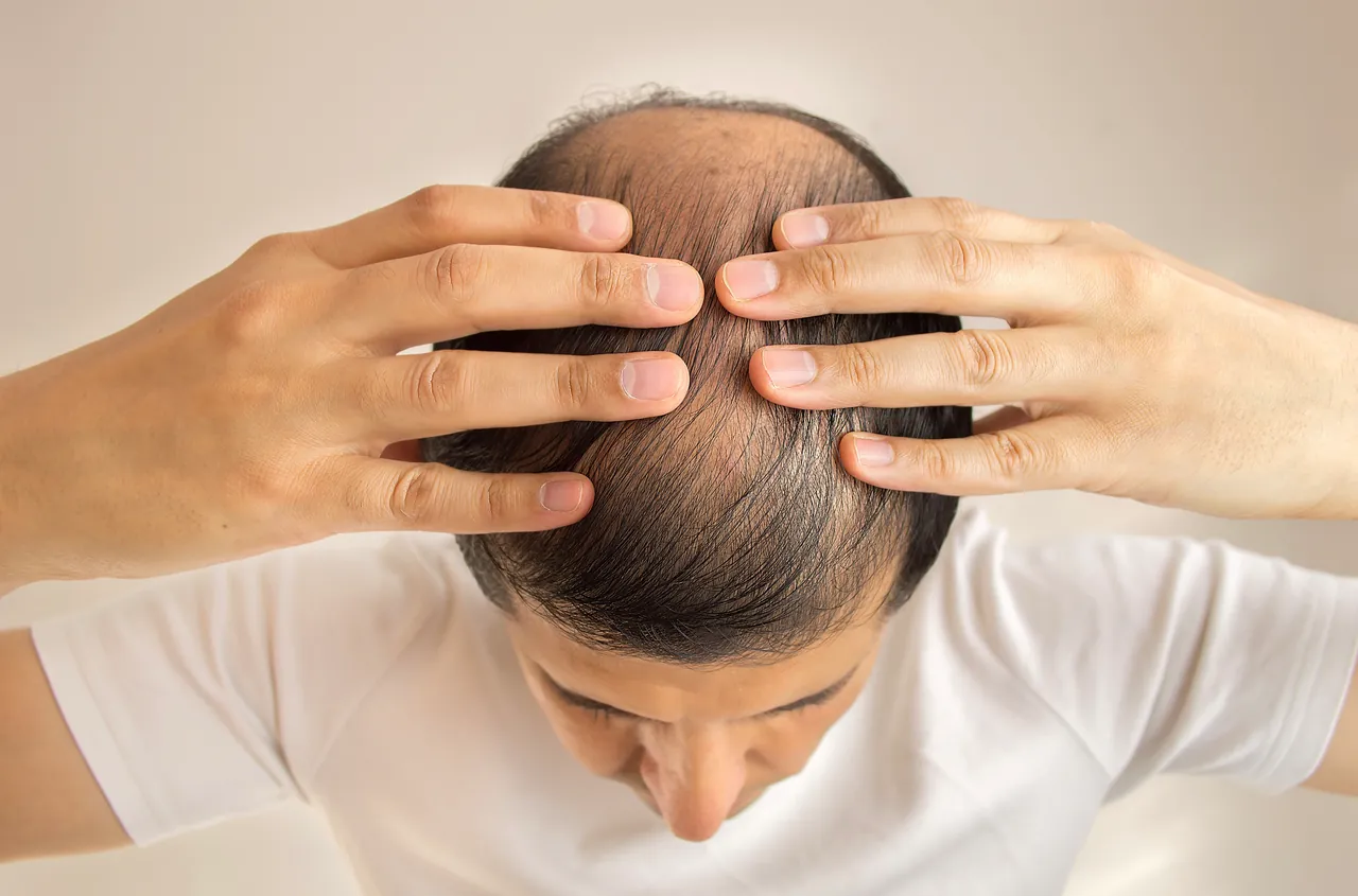 Prospective international patient discussing hair-transplant planning with a professional in a consultation setting.
