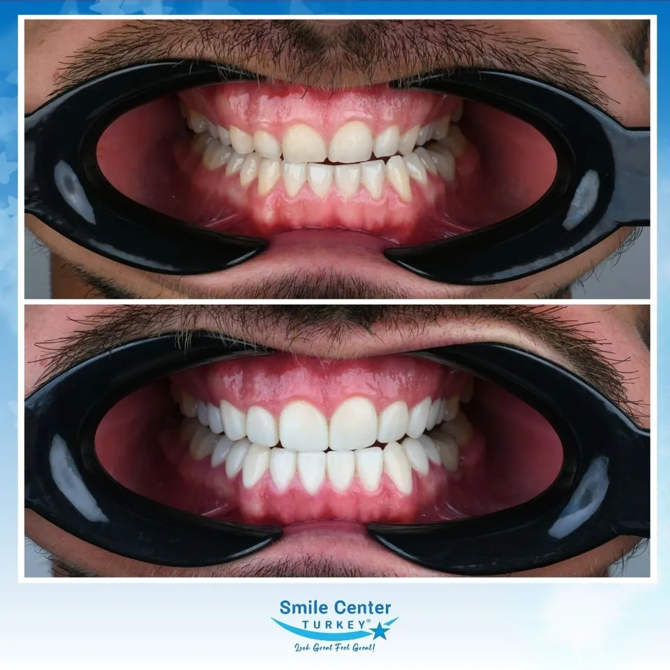 Upper and lower composite bonding case showing reshaped and evened front teeth
