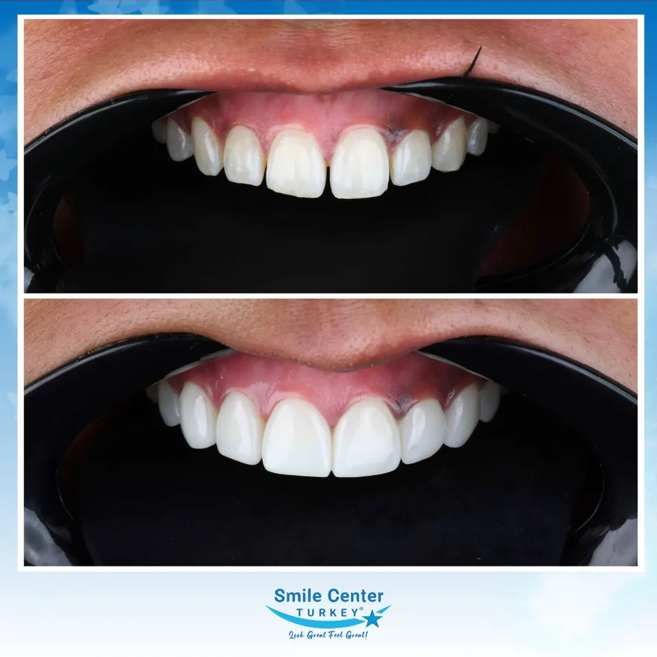 Composite bonding case restoring chipped upper front teeth