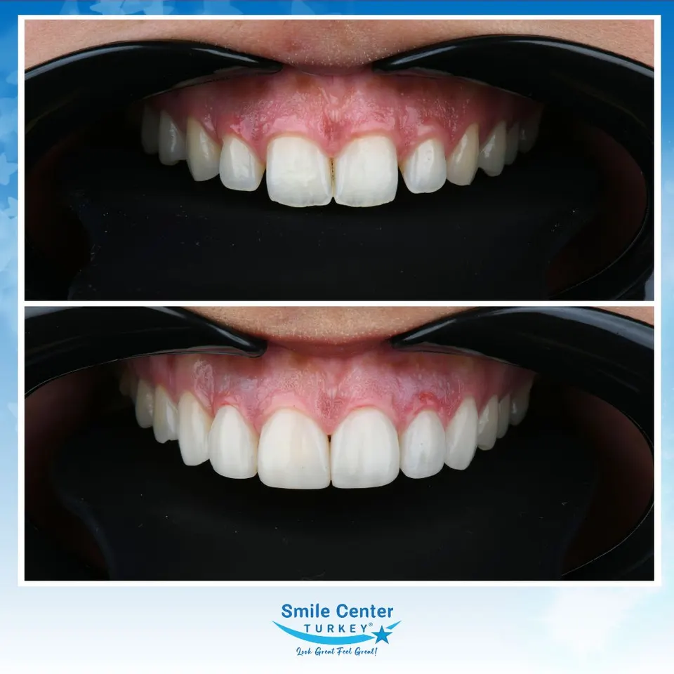 Composite bonding case improving shape and surface texture of the front teeth